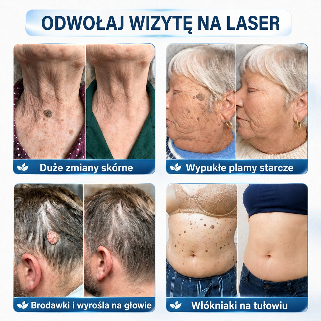🇵🇱 Wysokiej jakości polski produkt, szybka wysyłka krajowa | MURWON® 🖤 Plastry mikroigłowe zmniejszające widoczność niedoskonałości skóry 📍 (Na włókniaki,kurzajki, pieprzyki, przebarwienia i inne widoczne niedoskonałości skóry.) 🌥️