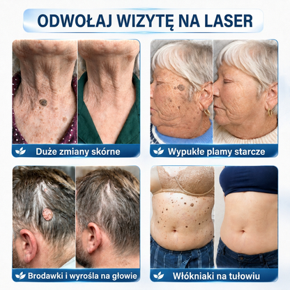 🇵🇱 Wysokiej jakości polski produkt, szybka wysyłka krajowa | MURWON® 🖤 Plastry mikroigłowe zmniejszające widoczność niedoskonałości skóry 📍 (Na włókniaki,kurzajki, pieprzyki, przebarwienia i inne widoczne niedoskonałości skóry.) 🌥️