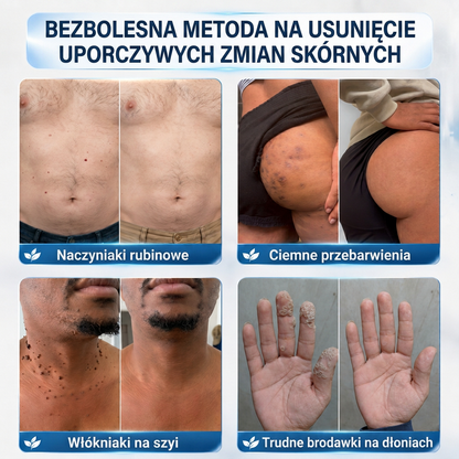 🇵🇱 Wysokiej jakości polski produkt, szybka wysyłka krajowa | MURWON® 💛 Plastry mikroigłowe zmniejszające widoczność niedoskonałości skóry 📍 (Na włókniaki,kurzajki, pieprzyki, przebarwienia i inne widoczne niedoskonałości skóry.) 🌥️